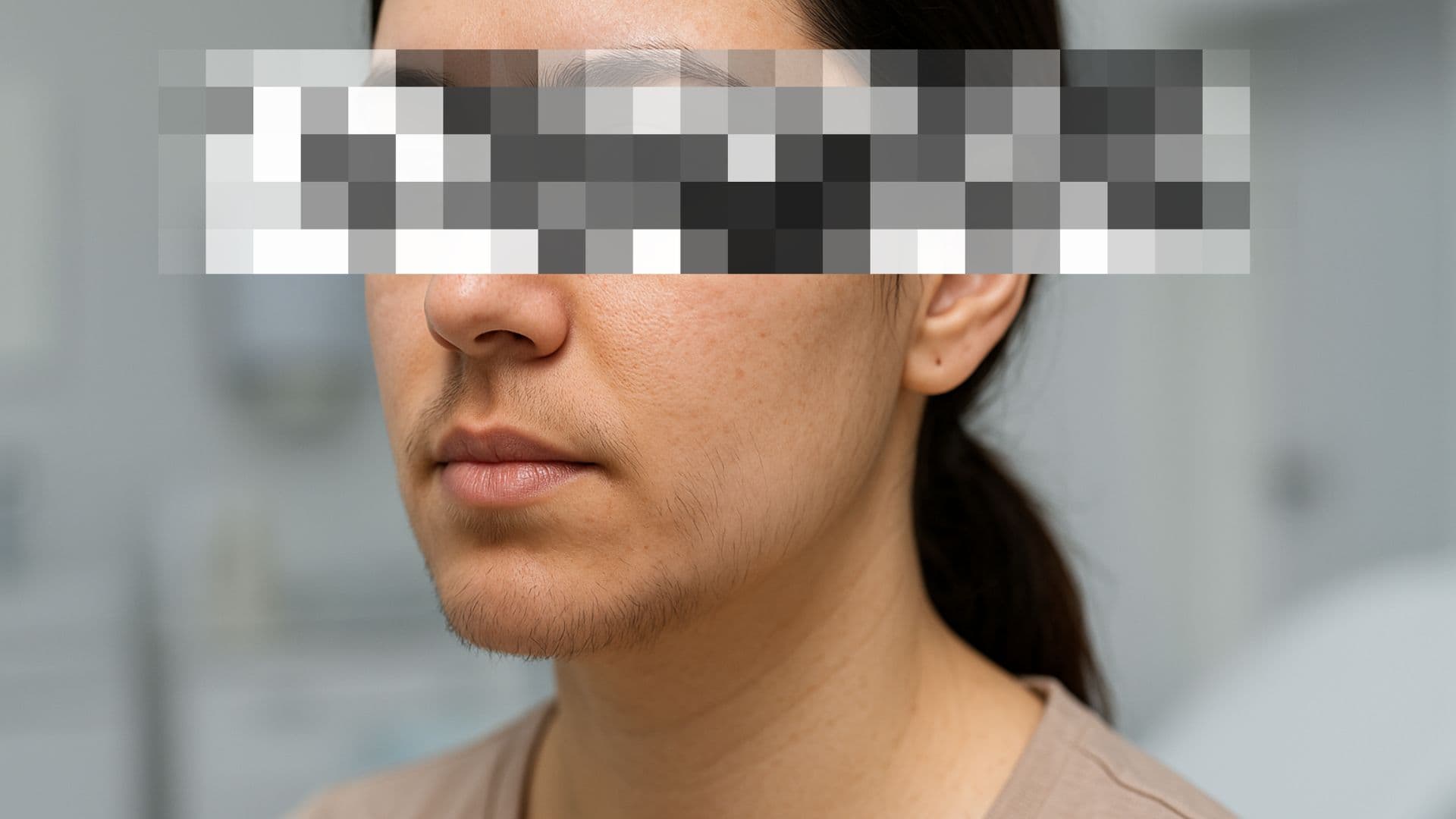 hypertrichose - remboursement épilation laser