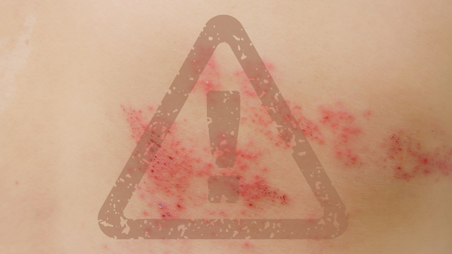 epilation laser low cost lyon