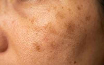 Blog 19 Taches brunes : tout savoir sur le traitement laser des lentigos solaires à Lyon