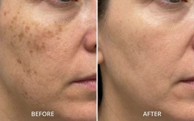 Prix du traitement des taches brunes au laser à Lyon : tarifs, devis et remboursement