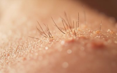 Épilation laser ratée : pourquoi ça ne fonctionne pas et comment corriger le traitement