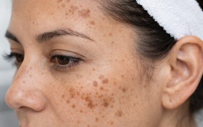 Actualités 2 Peeling ou laser pour traiter les taches brunes à Lyon ?