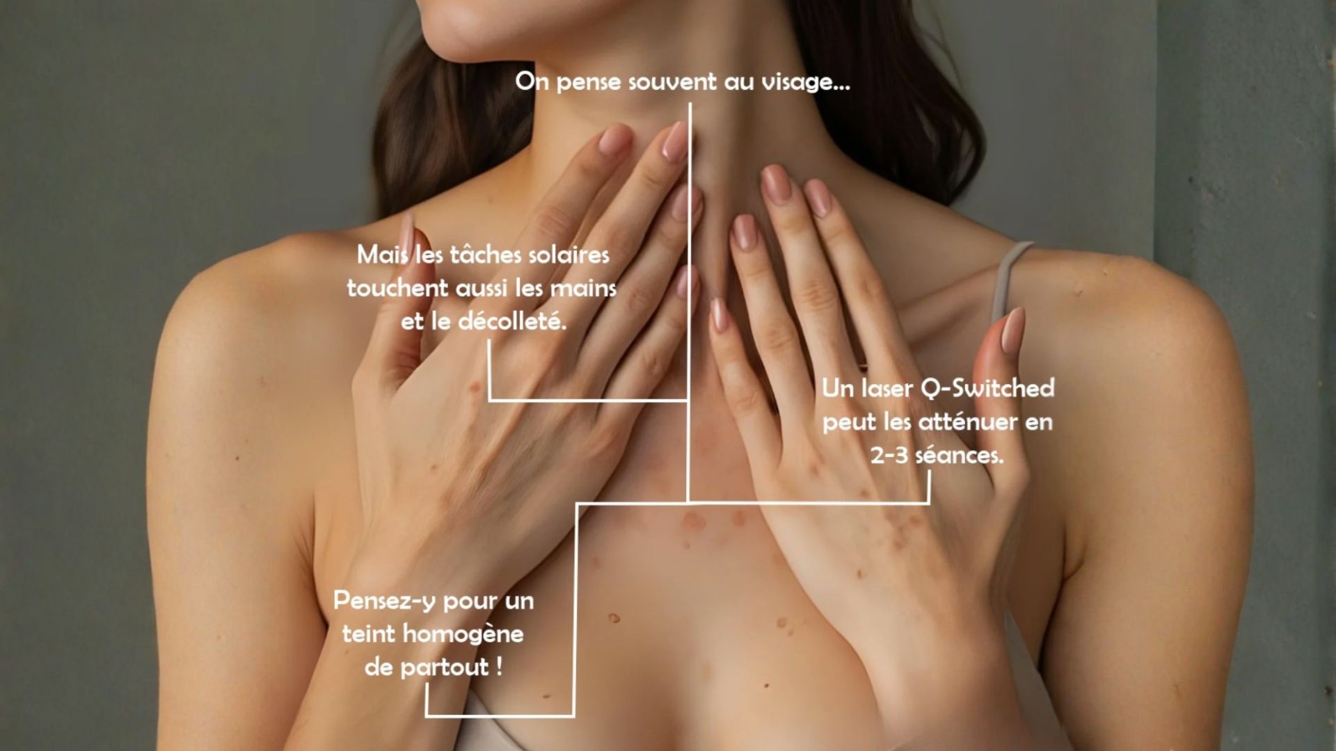 traitement laser lentigo mains et decollete