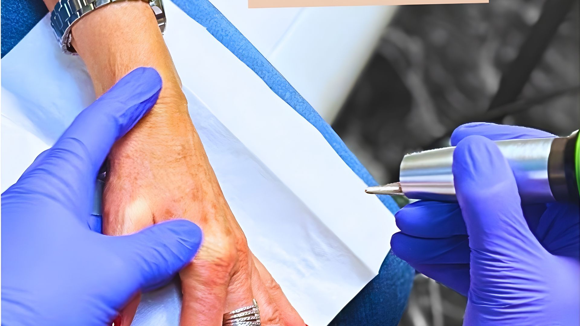 traitement lentigo solaire par laser à lyon